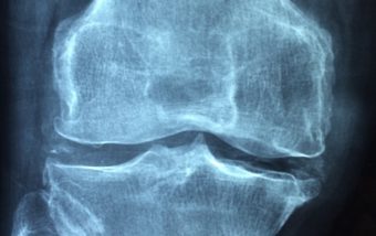 Santé : ostéoporose et intolérance au lactose, comment faire ?