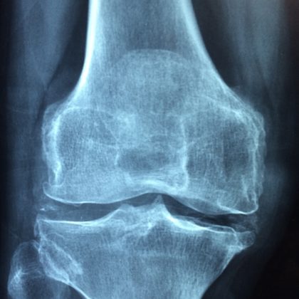 Salute: come affrontare l'osteoporosi e l'intolleranza al lattosio?